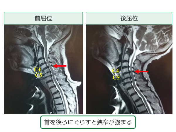 頸レントゲン写真