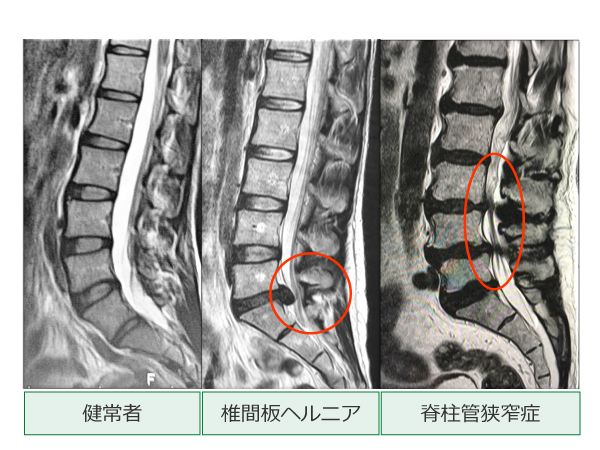 腰レントゲン写真
